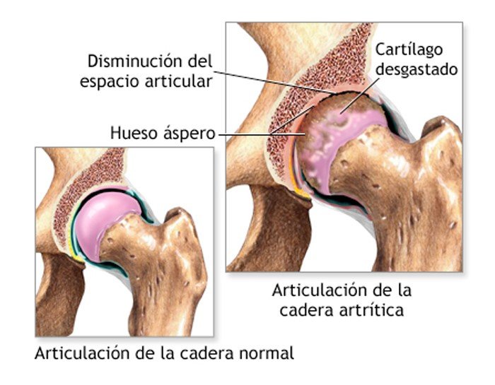 artritis de cadera