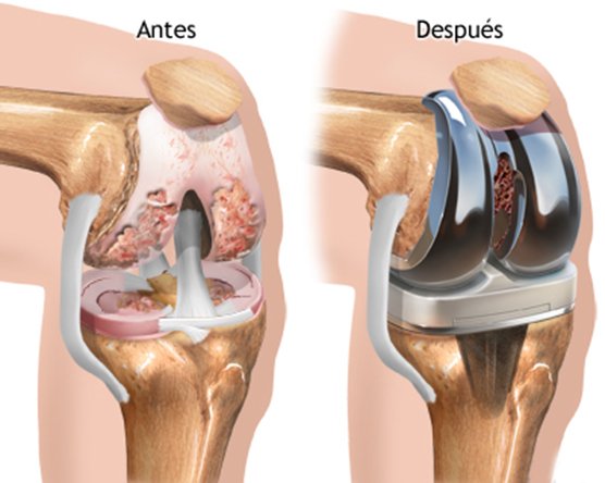 prótesis de rodilla